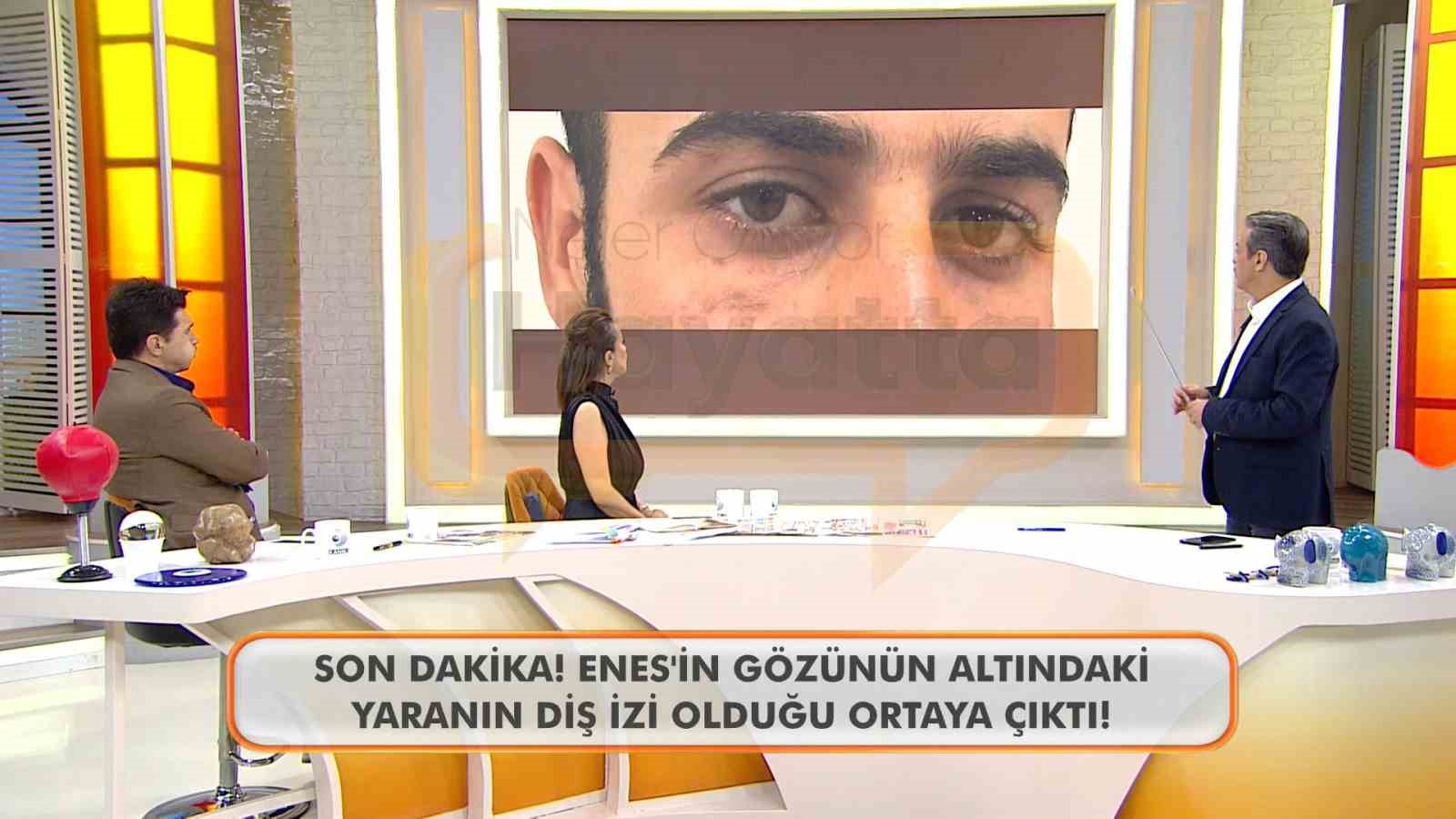 Canlı yayında Enes Güran’ın gözünün altındaki diş izine dikkat çekildi